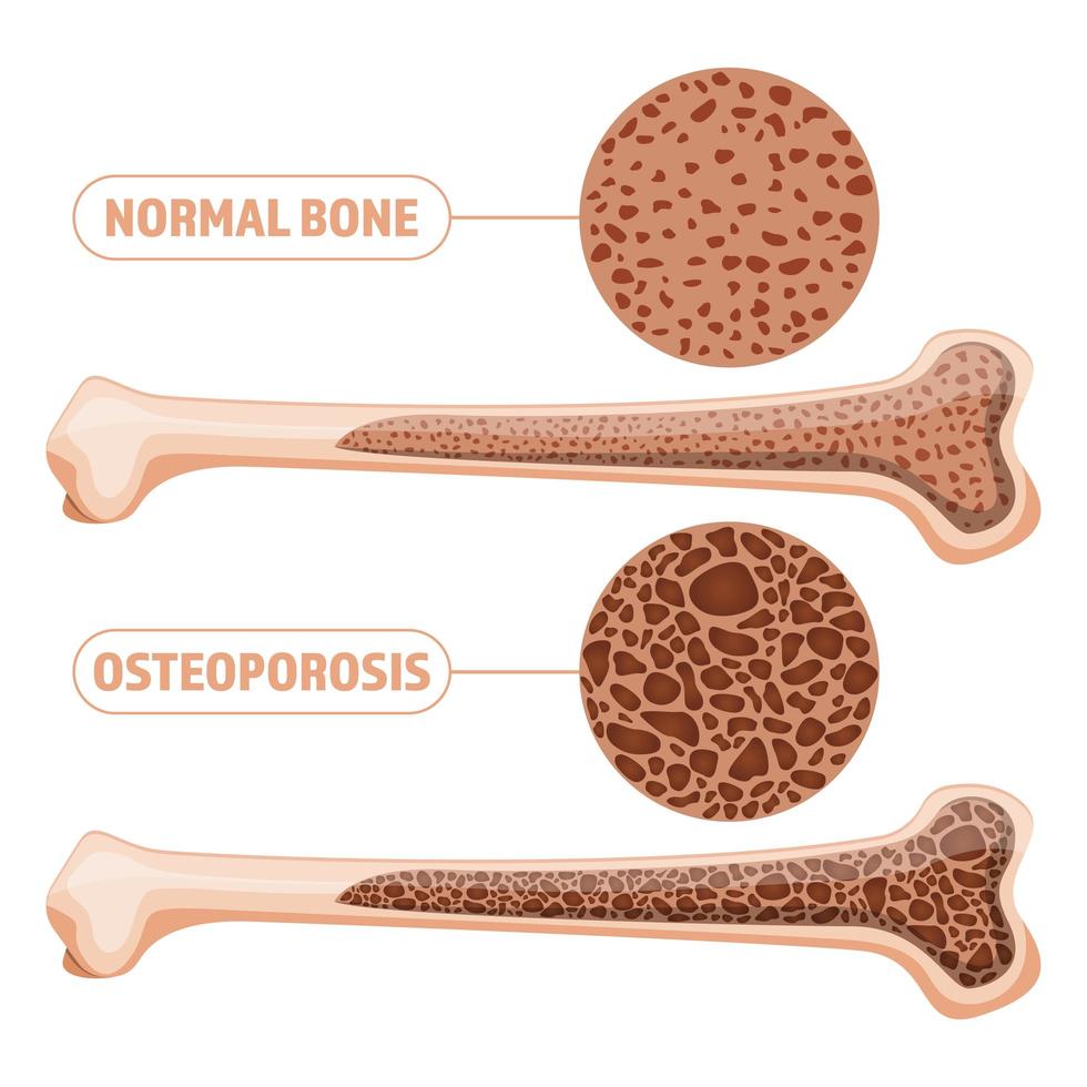 Osteoporosis